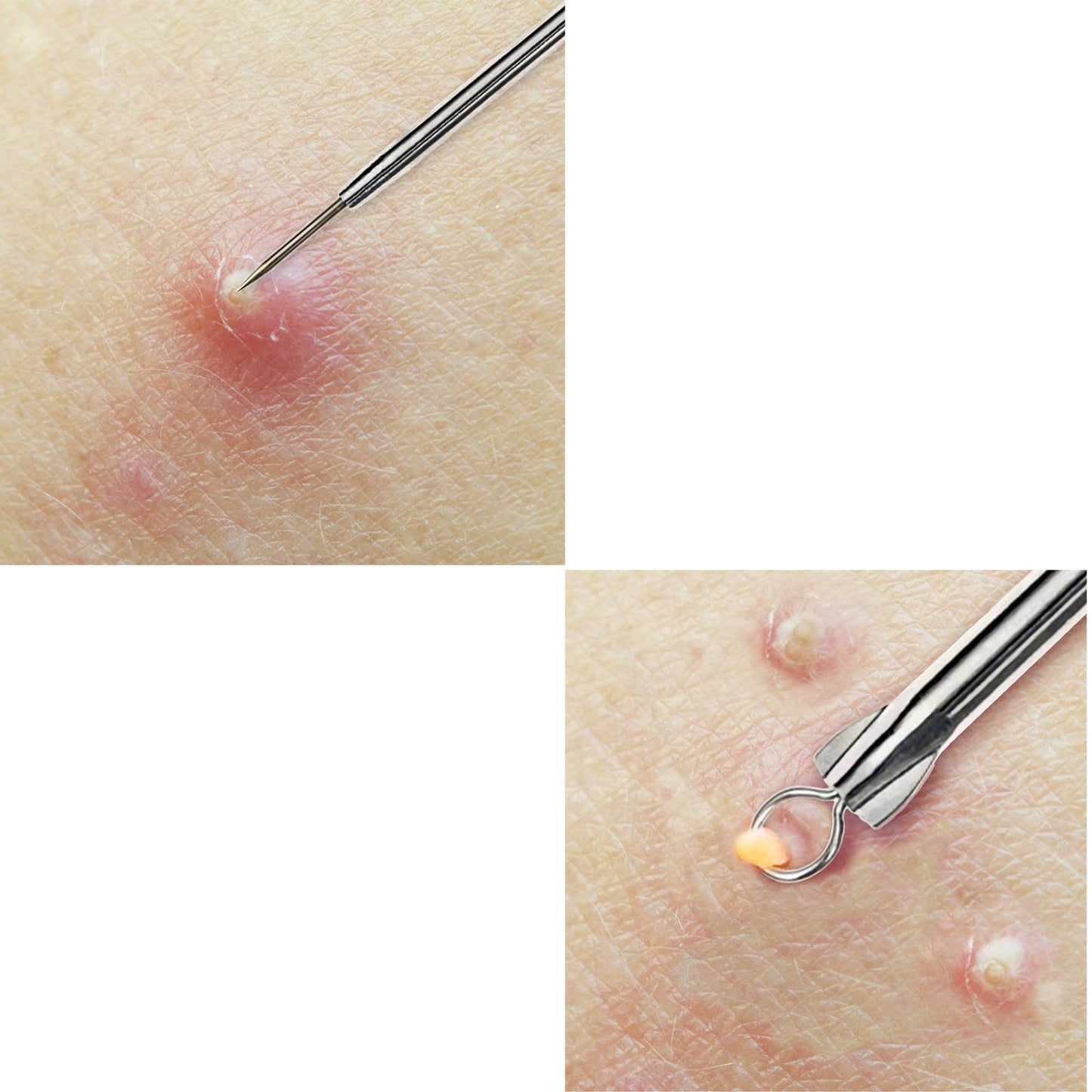 Acne Needle Cuticle Tool