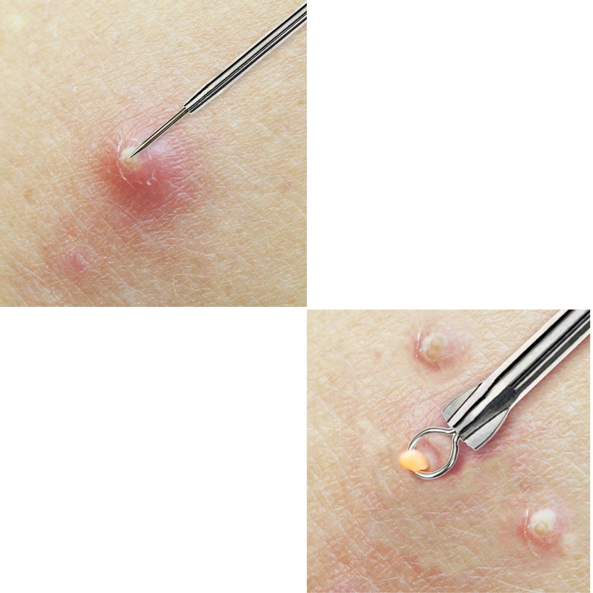 Acne Needle Cuticle Tool